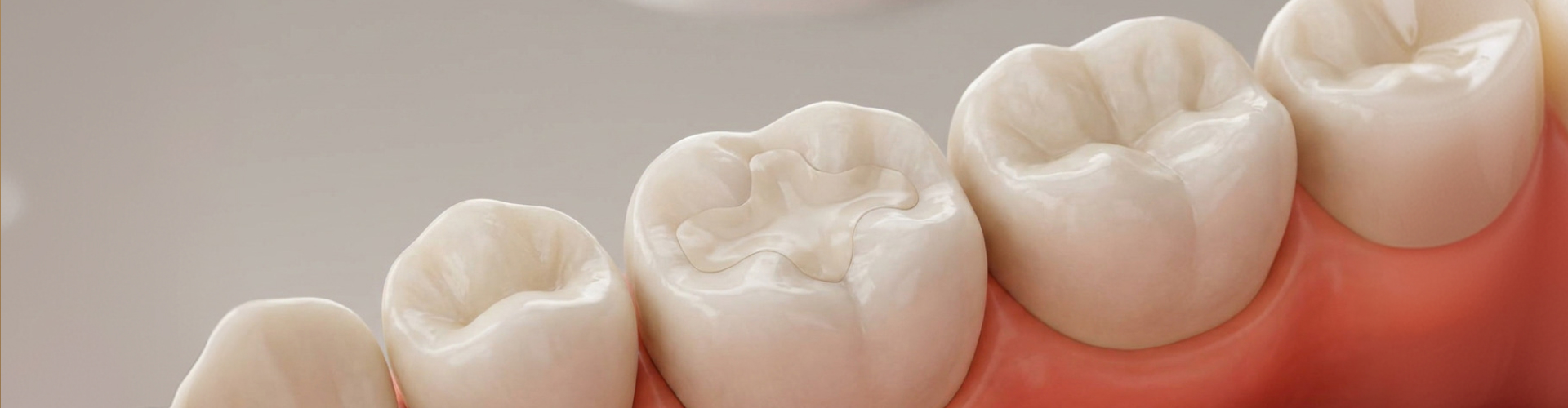 Illustration of a tooth-colored dental filling restoring a molar affected by a cavity at Cypress Family Dental.